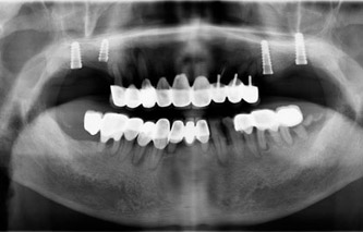 左右上颌四颗后牙种植修复